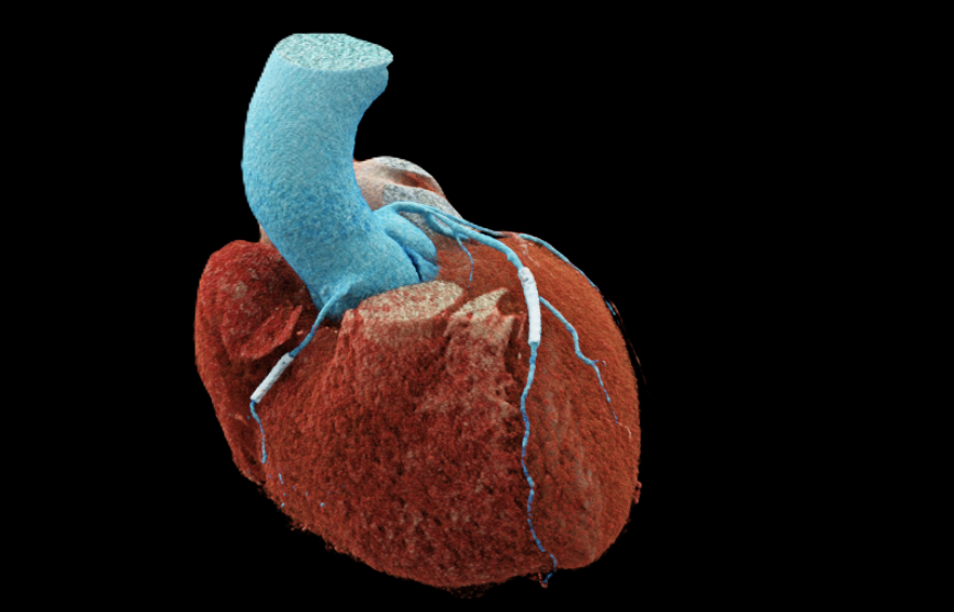 3D coronarography